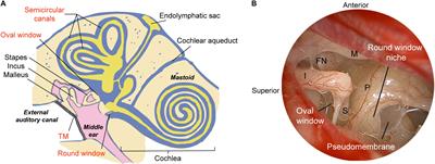 Gene Therapy for Human Sensorineural Hearing Loss